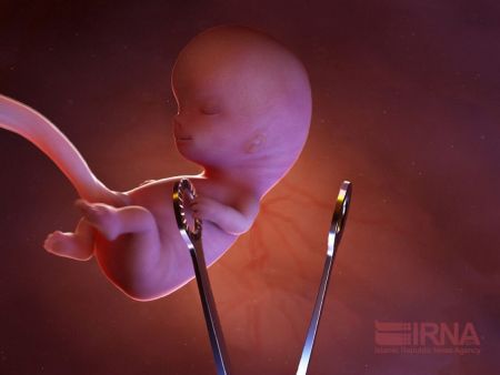 اخبار پزشکی ,خبرهای پزشکی ,سقط جنین اخبار پزشکی ,خبرهای پزشکی,سقط جنین