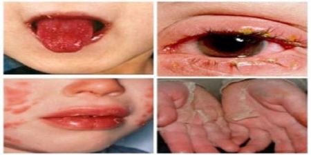 اخبار پزشکی ,خبرهای پزشکی ,کرونا اخبار پزشکی ,خبرهای پزشکی,کرونا