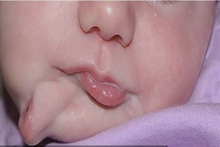 اخبارگوناگون,خبرهای گوناگون ,نوزادی با دو دهان اخبارگوناگون,خبرهای گوناگون ,نوزادی با دو دهان