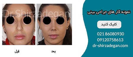 جراحی بینی گوشتی جراحی بینی گوشتی,عمل زیبایی بینی گوشتی,هزینه جراحی بینی گوشتی