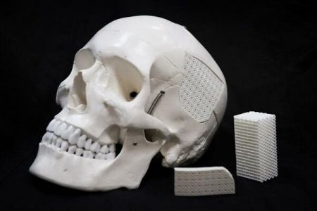 اخبار پزشکی ,خبرهای پزشکی , ایمپلنت اخبار پزشکی ,خبرهای پزشکی, ایمپلنت