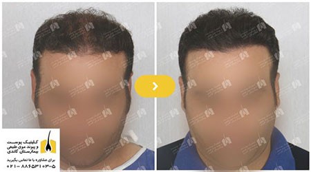 کاشت مو کاشت مو,جراحی کاشت مو