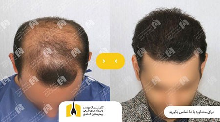 جراحی کاشت مو کاشت مو,جراحی کاشت مو