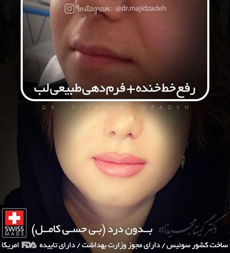 تزریق ژل لب تزریق ژل لب,تزریق ژل,تزریق ژل به لب