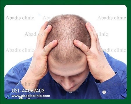انواع روش کاشت مو بهترین روش کاشت مو,کاشت مو,انواع روش کاشت مو