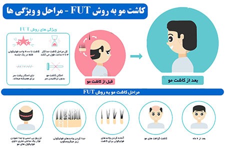 کاشت مو طبیعی به روش FUT کاشت مو طبیعی,کاشت مو,انواع روش کاشت مو