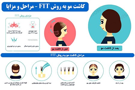 کاشت مو طبیعی به روش FIT کاشت مو طبیعی,کاشت مو,انواع روش کاشت مو