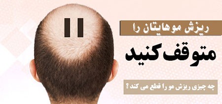ریزش مو ریزش مو,علل ریزش مو,درمان ریزش مو