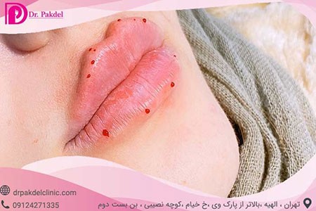 تزریق ژل لب تزریق ژل لب,تزریق ژل چیست