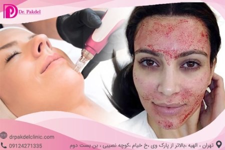 میکرونیدلینگ میکرونیدلینگ,میکرونیدلینگ چیست,مزایای میکرونیدلینگ صورت