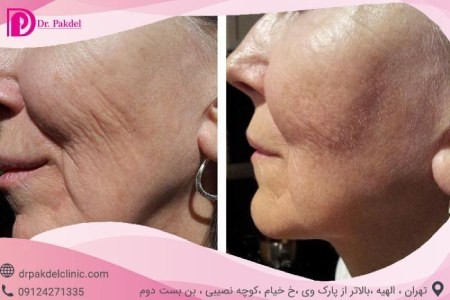 مزایای میکرونیدلینگ صورت میکرونیدلینگ,میکرونیدلینگ چیست,مزایای میکرونیدلینگ صورت