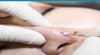 لیفت بینی بدون جراحی لیفت بینی,لیفت بینی بدون جراحی,لیفت بینی با نخ