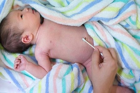 عفونت بند ناف نوزاد افتادن بند ناف,بند ناف نوزاد