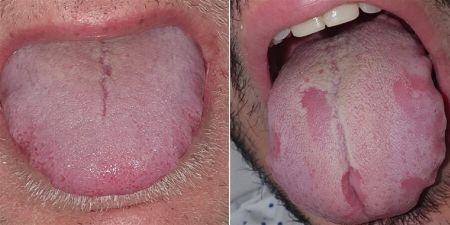 اخبار پزشکی ,خبرهای پزشکی ,زبان کووید اخبار پزشکی ,خبرهای پزشکی,زبان کووید