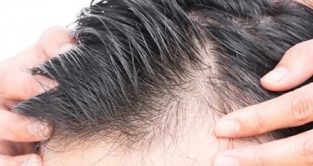 انواع روش های کاشت مو کاشت مو,انواع روش های کاشت مو