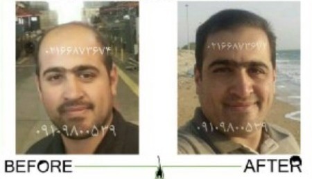 درمان ریزش مو درمان ریزش مو,درمان ریزش مو با محصولات رویش سبز لاوین