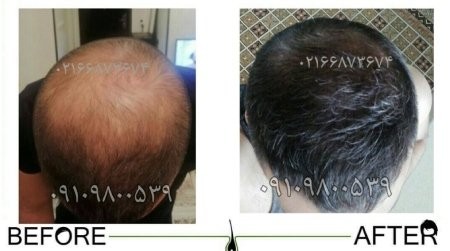 درمان ریزش مو,درمان ریزش مو با محصولات رویش سبز لاوین