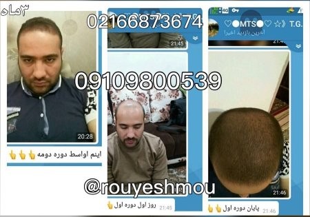 محصول رویش سبز لاوین درمان ریزش مو,درمان ریزش مو با محصولات رویش سبز لاوین