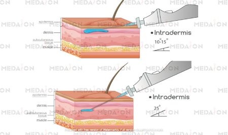 کربوکسی تراپی کربوکسی تراپی,کربوکسی تراپی چیست,تزریق کربوکسی تراپی