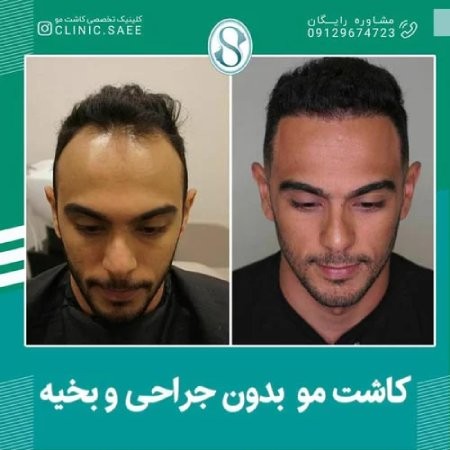 عکس کاشت مو در کلینیک ساعی بهترین روش های کاشت مو در ایران,کاشت مو