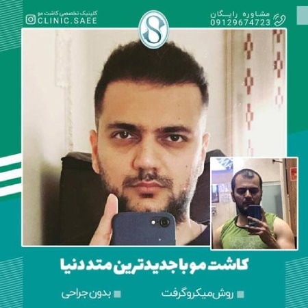 نمونه عکس کاشت مو به روش میکروگرافت بهترین روش های کاشت مو در ایران,کاشت مو