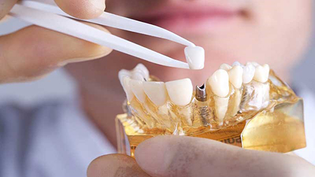 رشته ساخت پروتز های دندانی بدون کنکور, متخصص حرفه ای پروتز دندان, دروس رشته تکنسین پروتز های دندانی