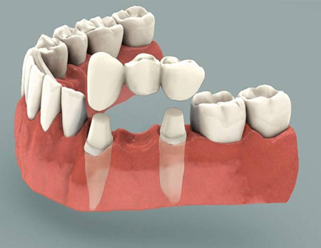 شناخت بریج دندانی,بریج دندانی چیست