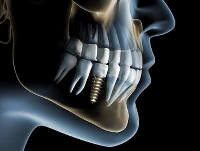 درباره ایمپلنت دندان,شناخت ایمپلنت
