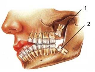 مراقب عوارض دندان عقل باشيد