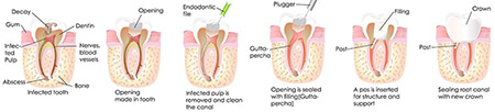درمان و ترمیم دندان,عصب کشی چیست