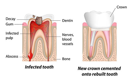 عصب کشی دندان چیست,دوام دندان عصب کشی شده