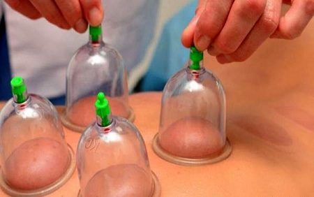انجام بادکش درمانی برای لاغری بادکش شکم , خواص بادکش , لاغری با بادکش