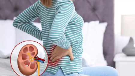 نکات ورزش با سنگ کلیه, تاثیر ورزش بر دفع سنگ کلیه
