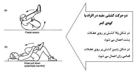 گودی کمر,ورزش برای از بین بردن گودی کمر,درمان گودی کمر