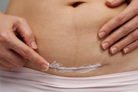 نکات پس از سزارین