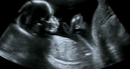 تصاویر سونوگرافی جنین دختر و پسر, سونوگرافی جنین دختر