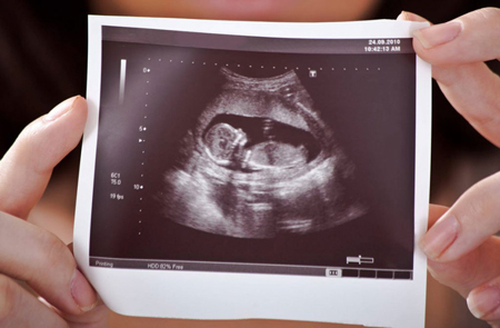 غربالگری سه ماهه اول ,سه ماهه اول بارداری ,غربالگری سه ماهه اول بارداری