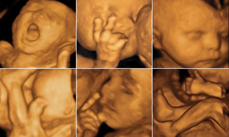 سونوگرافی چهار بعدی, سونوگرافی چهار بعدی چیست, سونوگرافی چهار بعدی جنین