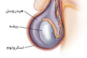 آب آوردن بیضه,هیدروسل چیست,علل هیدروسل