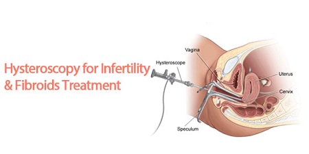 هیستروسکوپی, درمان نازایی با هیستروسکوپی, عمل هیستروسکوپی
