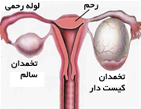 تنبلی تخمدان, درمان تنبلی تخمدان, تنبلی تخمدان و بارداری