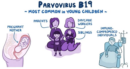  پیشگیری از ابتلا به پاروویروس, تأثیر بیماری پنجم بر جنین, بیماری پاروویروس در بارداری