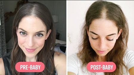 ریزش مو در دوران شیردهی, درمان خانگی نازک شدن مو بعد از زایمان, نازک شدن موها بعد از زایمان