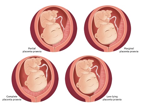 عوارض پایین بودن جفت در بارداری, تشخیص پایین بودن جفت در بارداری, درمان علایم پایین بودن جفت در بارداری