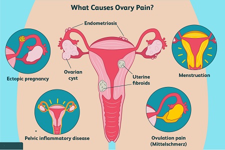 درد رحم در اوایل بارداری, درد تخمدان راست در اوایل بارداری, درد تخمدان در بارداری