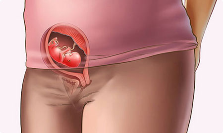 شیاف پروژسترون در بارداری,عوارض شیاف پروژسترون در بارداری,تاثیر شیاف پروژسترون در بارداری