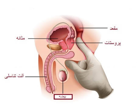 عوارض ماساژ پروستات,مضرات ماساژ پروستات,معایب ماساژ پروستات