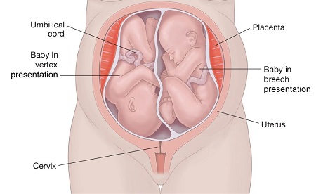 وضعیت قرارگیری جنین در رحم, بارداری دوقلو, وضعیت سرپایین دوقلوها, انواع وضعیت قرارگیری جنین های دوقلو