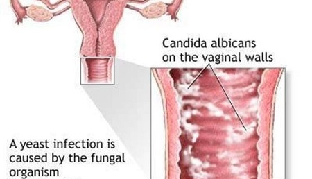 دلایل عفونت قارچی واژن در بارداری, درمان عفونت قارچی, عوارض عفونت قارچی واژن در بارداری