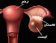 تخمدان‌ها,تنبلی تخمدان